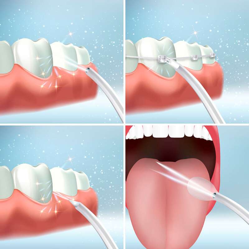 Irrigador periodontal
